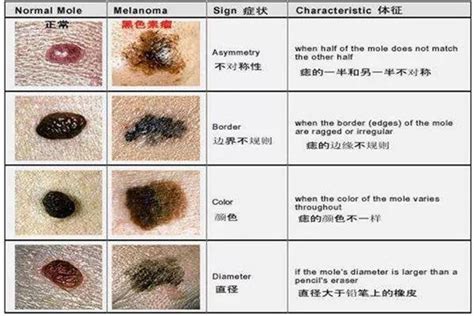 胎記痣|胎记的类型（胎记图片）